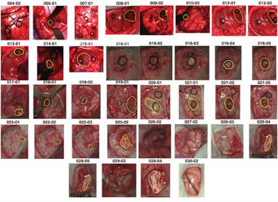 Intelligent tumor tissue classification for Hybrid Health Care Units